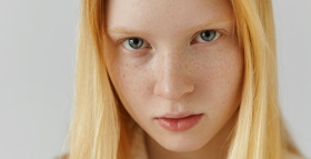 Картинка - Гиперпигментация кожи