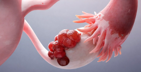 Картинка - Киста яичника: виды и как вовремя выявить патологию