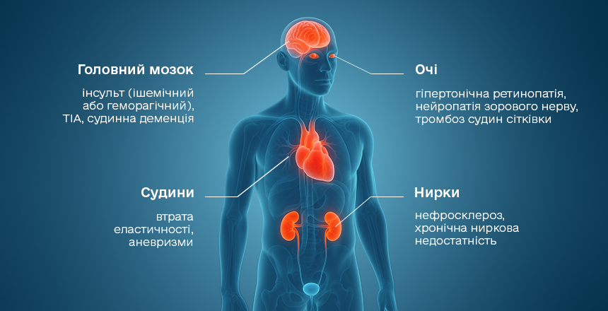 наслідки гіпертонічної хвороби