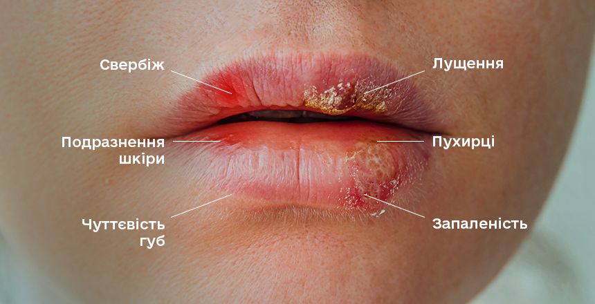 симптоми герпесу