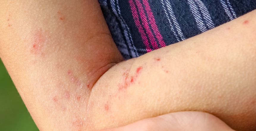 Фото - Тромбоцитопенія як маркер первинного імунодефіциту