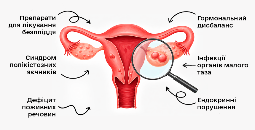 причини виникнення кісти яєчника