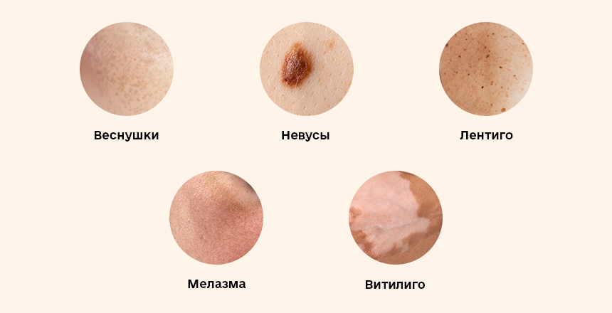 виды гиперпигментации 